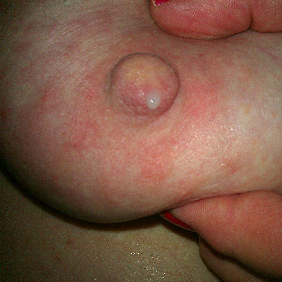 Nipples Lactation 73